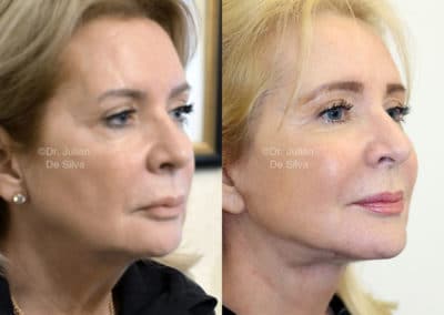 Facelift in London Before & After Results