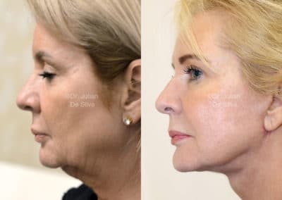 Facelift in London Before & After Results