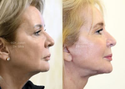 Facelift in London Before & After Results