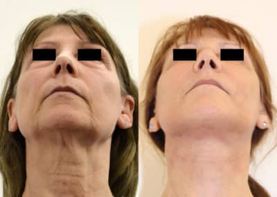 Facelift in London Before & After Results