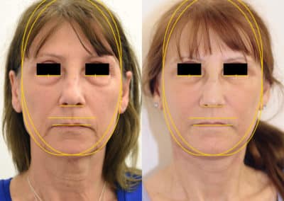 Facelift in London Before & After Results