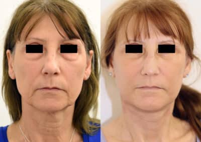 Facelift in London Before & After Results