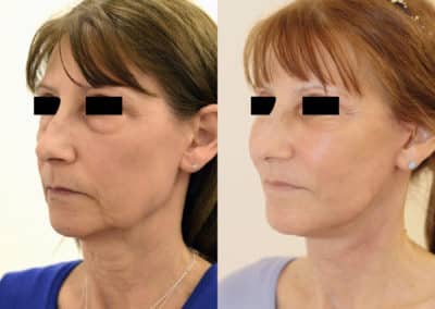 Facelift in London Before & After Results