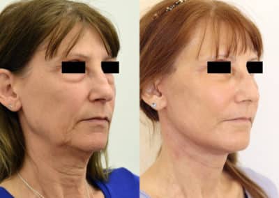 Facelift in London Before & After Results