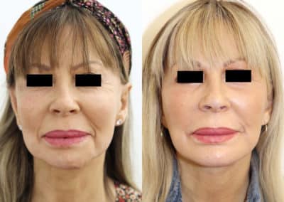 Facelift in London Before & After Results