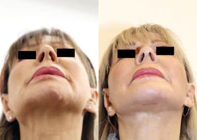 Facelift in London Before & After Results