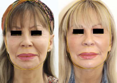 Facelift in London Before & After Results