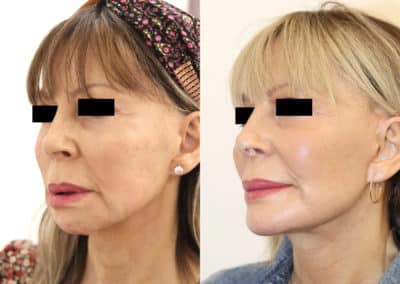 Facelift in London Before & After Results