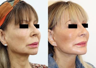 Facelift in London Before & After Results