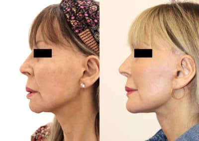 Facelift in London Before & After Results