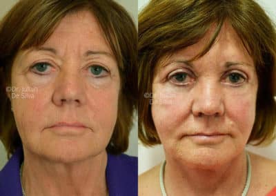 Facelift in London Before & After Results