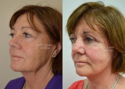 Facelift in London Before & After Results