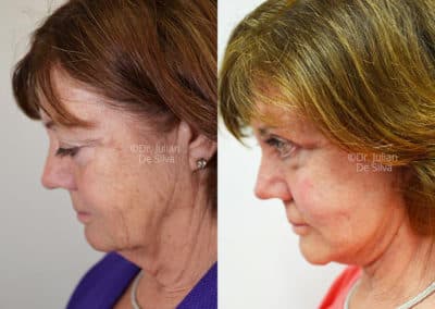 Facelift in London Before & After Results