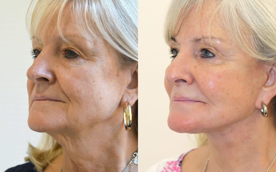 Turn Back the Clock: Exploring Modern Facelift Innovations