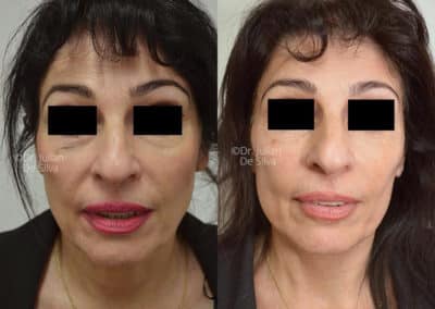 Facelift in London Before & After Results