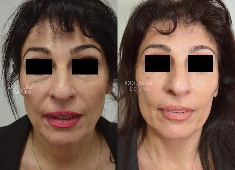 Facelift in London Before & After Results