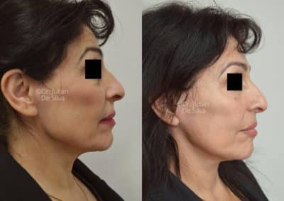 Facelift in London Before & After Results