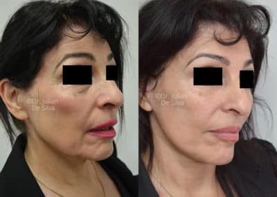 Facelift in London Before & After Results