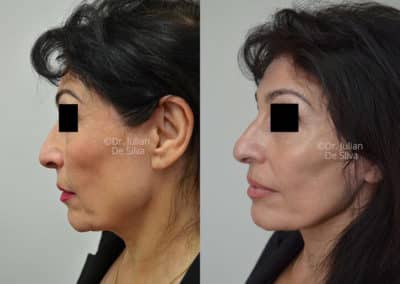 Facelift in London Before & After Results