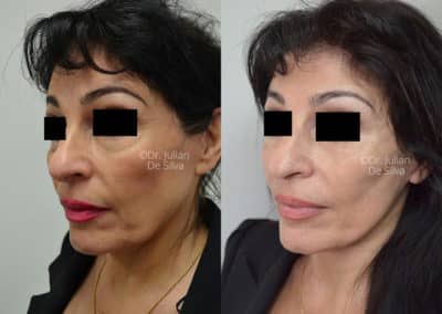 Facelift in London Before & After Results