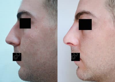 Rhinoplasty in London Before & After Results