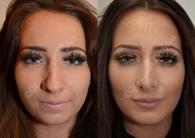 Rhinoplasty in London Before & After Results