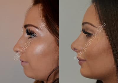 Rhinoplasty in London Before & After Results