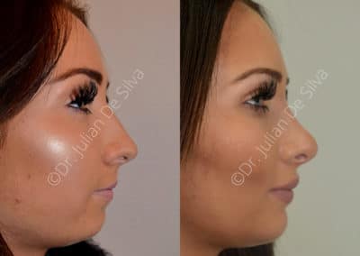 Rhinoplasty in London Before & After Results