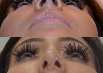 Rhinoplasty in London Before & After Results