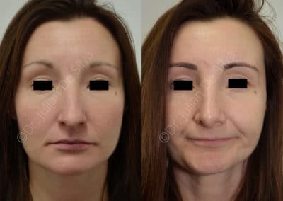 Rhinoplasty in London Before & After Results