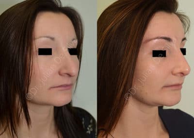 Rhinoplasty in London Before & After Results