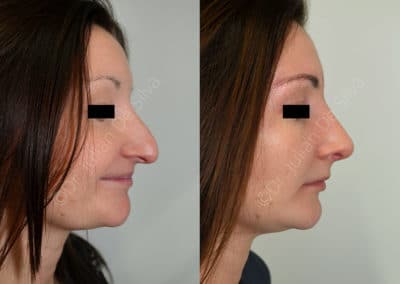 Rhinoplasty in London Before & After Results