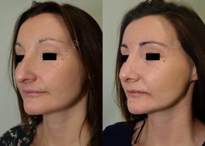 Rhinoplasty in London Before & After Results