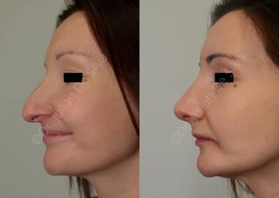 Rhinoplasty in London Before & After Results