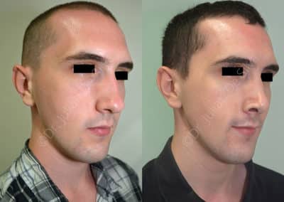 Rhinoplasty in London Before & After Results