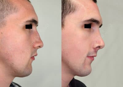 Rhinoplasty in London Before & After Results