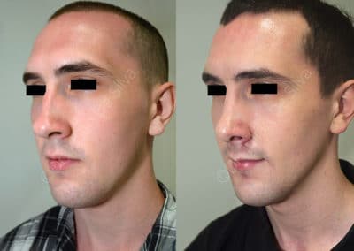 Rhinoplasty in London Before & After Results