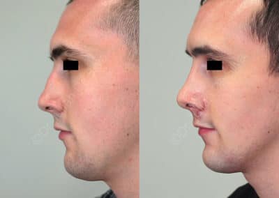 Rhinoplasty in London Before & After Results