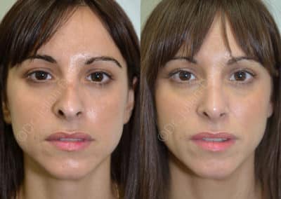 Rhinoplasty in London Before & After Results