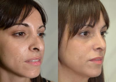 Rhinoplasty in London Before & After Results