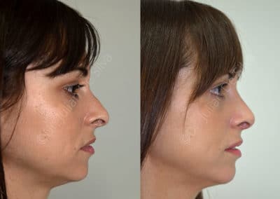 Rhinoplasty in London Before & After Results