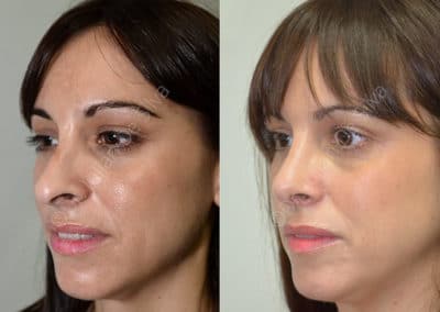 Rhinoplasty in London Before & After Results