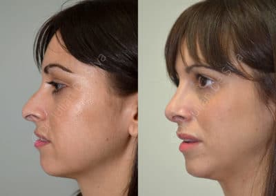 Rhinoplasty in London Before & After Results