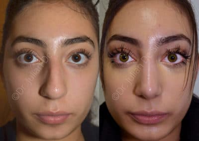 Rhinoplasty in London Before & After Results