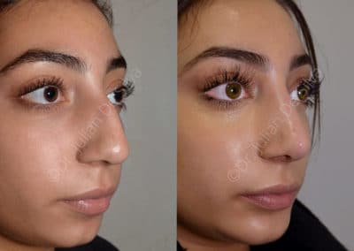 Rhinoplasty in London Before & After Results