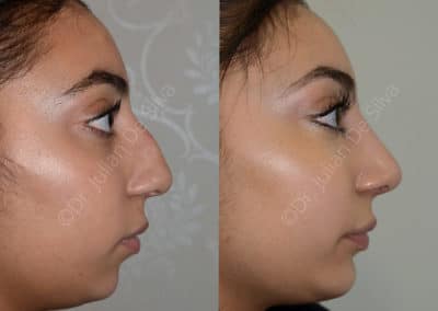 Rhinoplasty in London Before & After Results