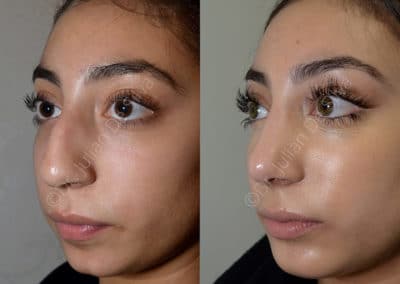 Rhinoplasty in London Before & After Results