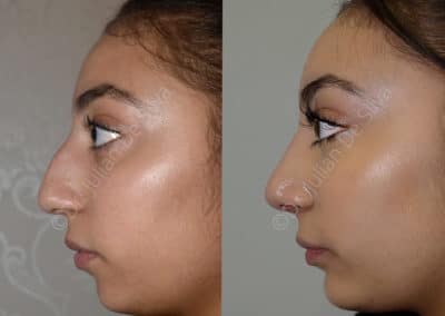 Rhinoplasty in London Before & After Results