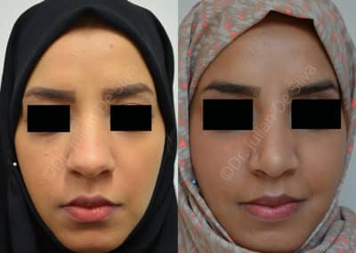 Rhinoplasty in London Before & After Results