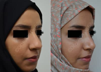 Rhinoplasty in London Before & After Results